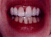 Tooth Whitening Picture